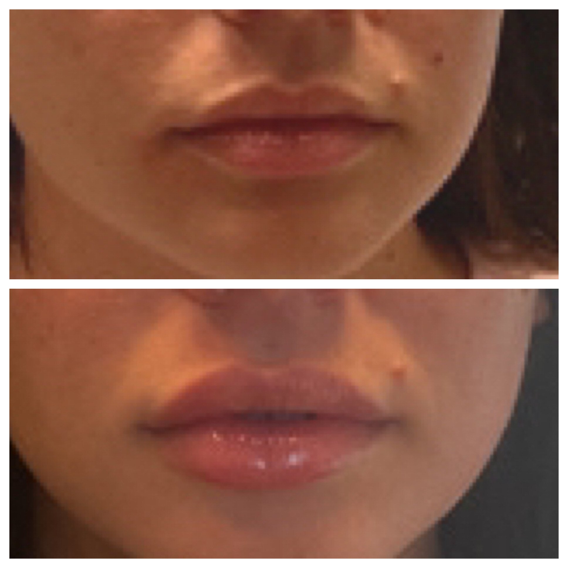 Injectables 6