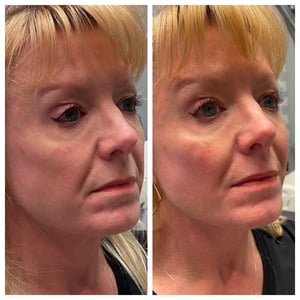 Laser Resurfacing Before and After