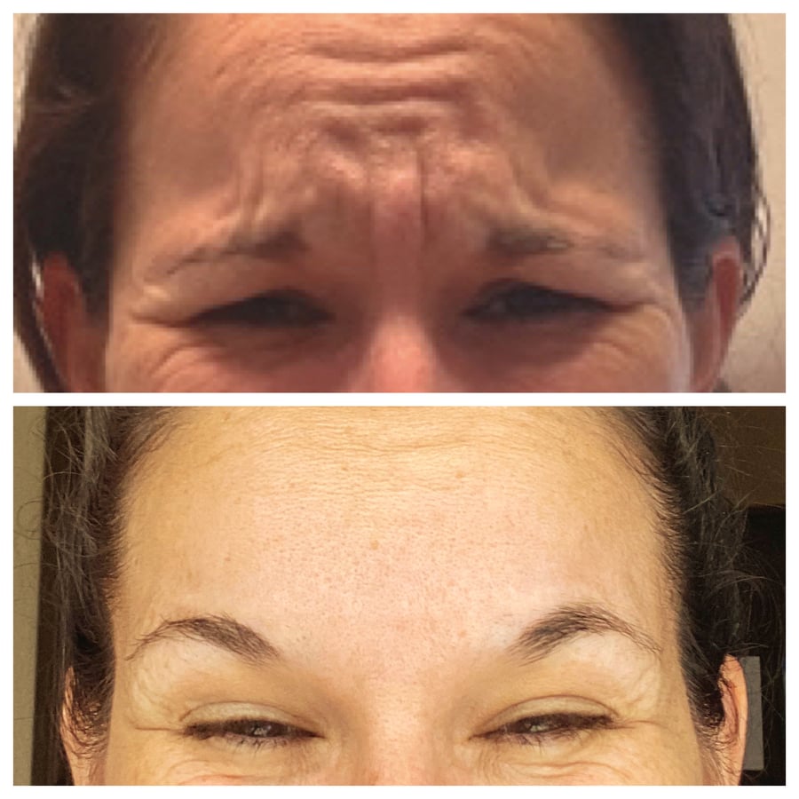 Forehead line injectable treatment result