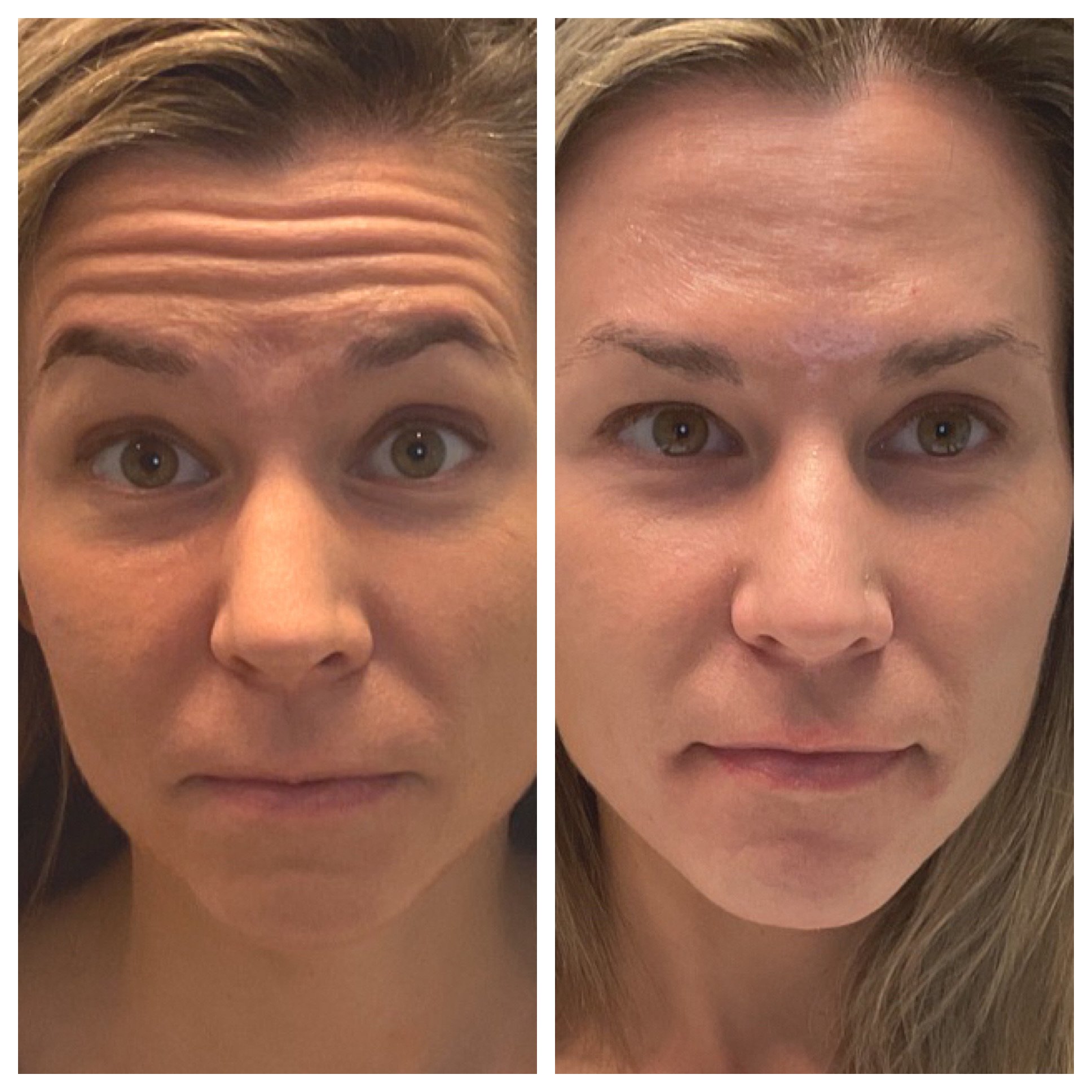 Injectables 4