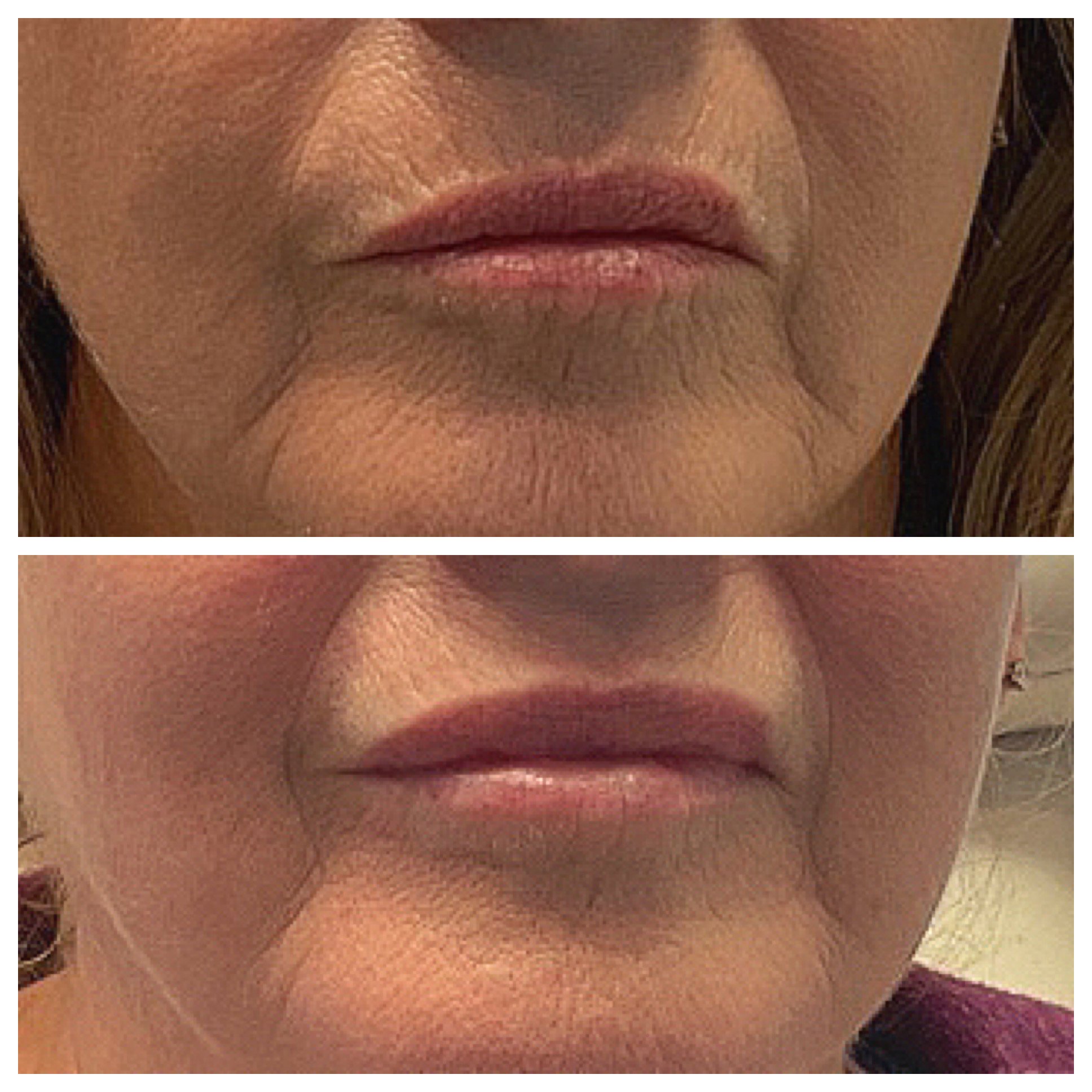 botox-mouth