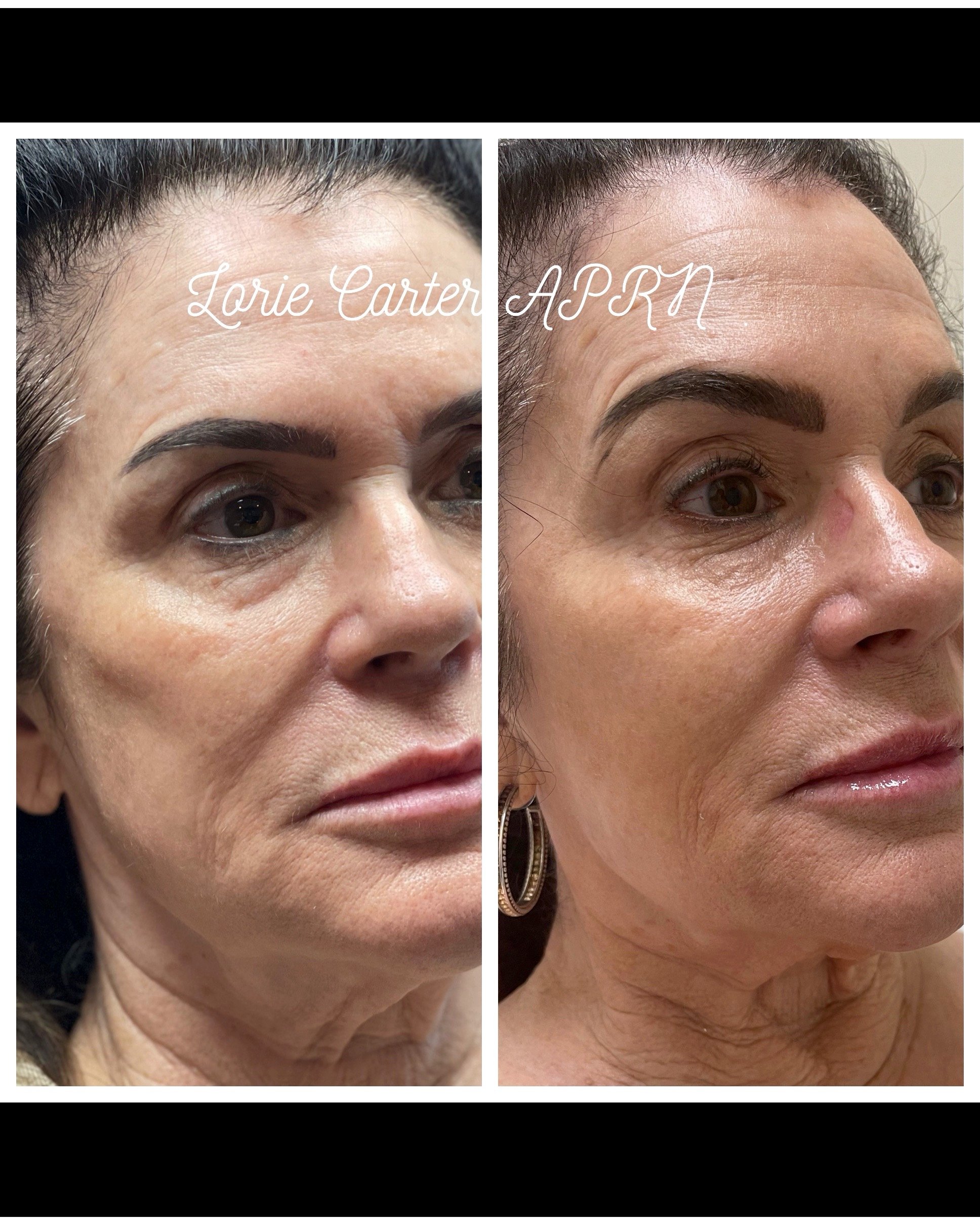 sculptra pic