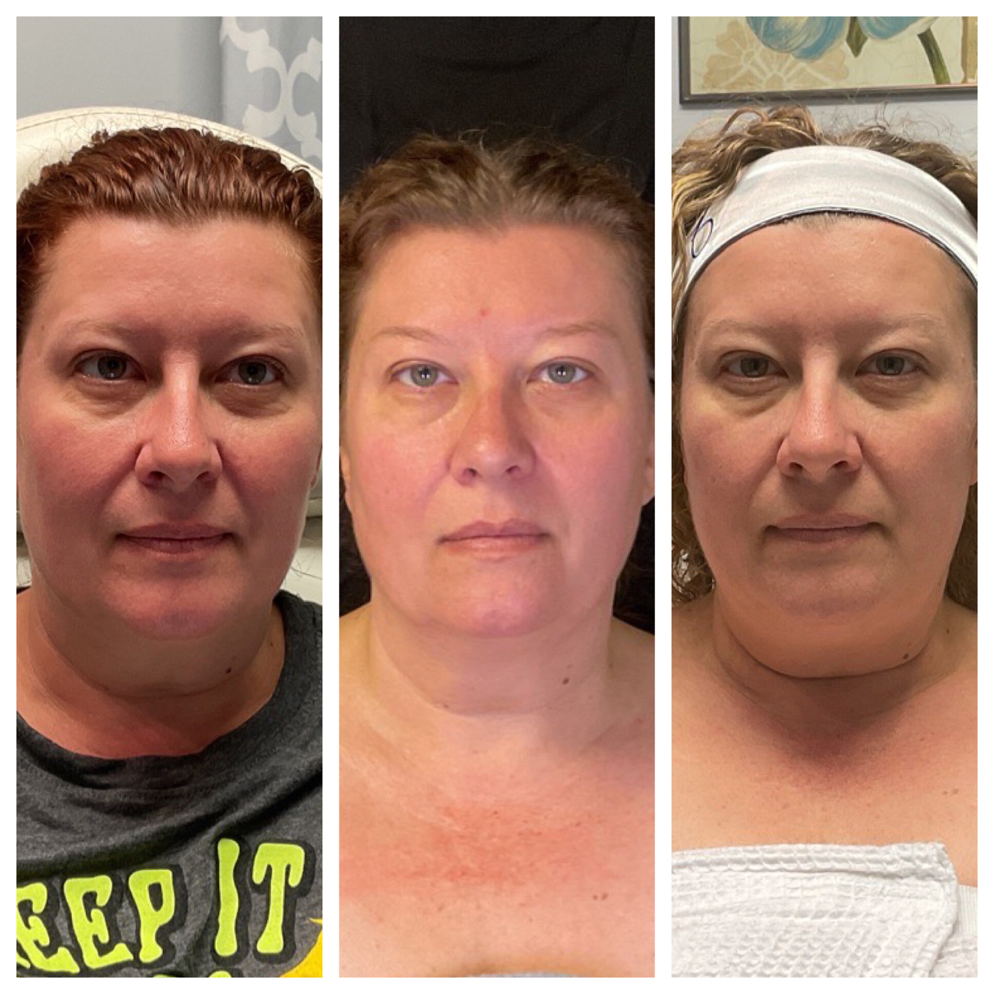 Laser Light Treatment 1