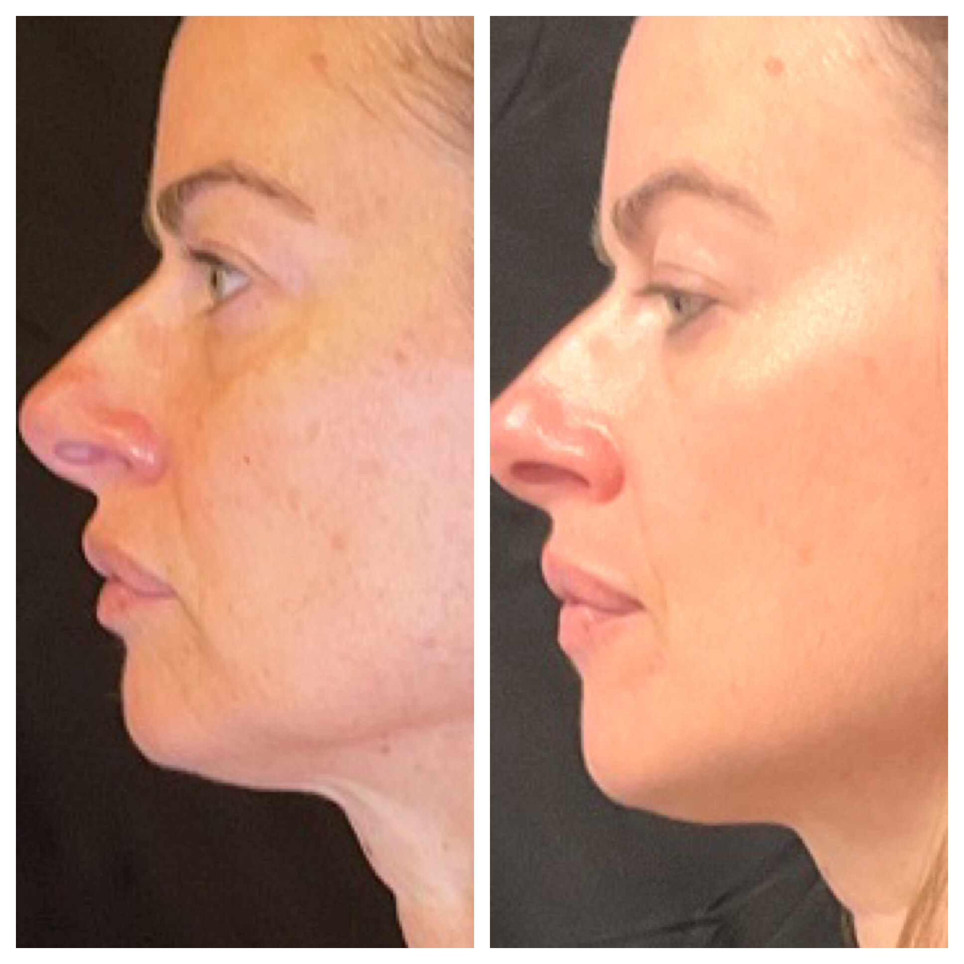 Laser Light Treatment 5