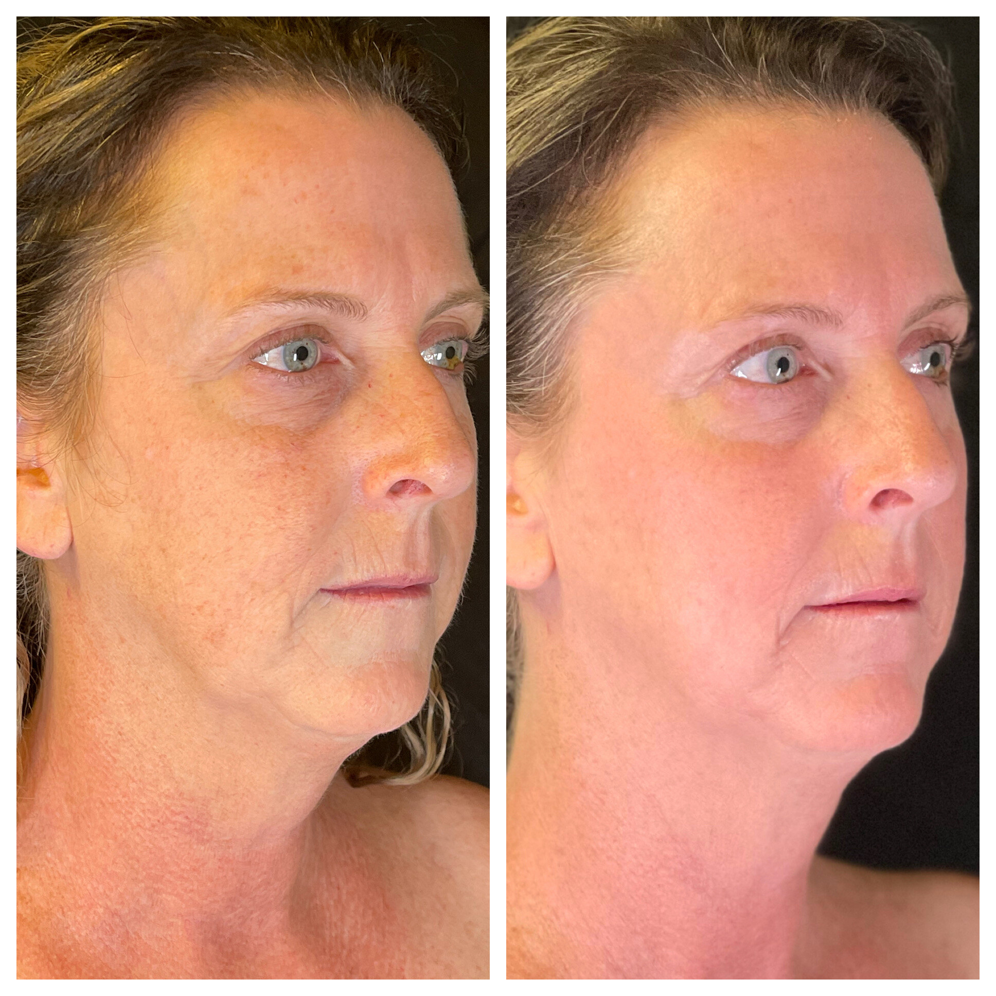 Laser Light Treatment 3
