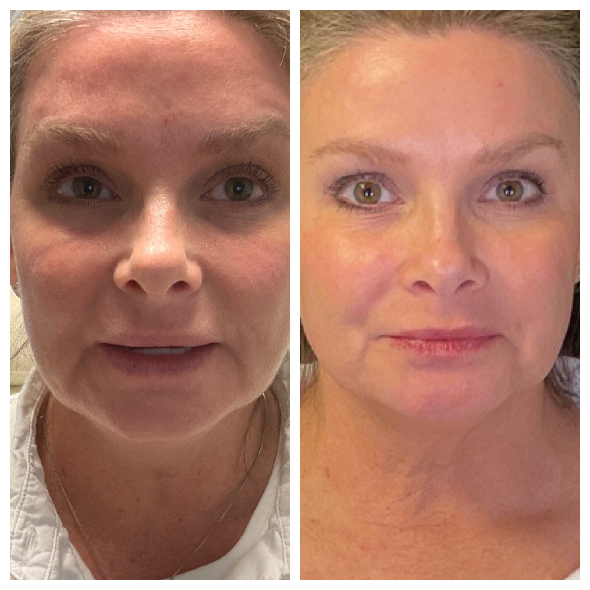 Laser Light Treatment 6