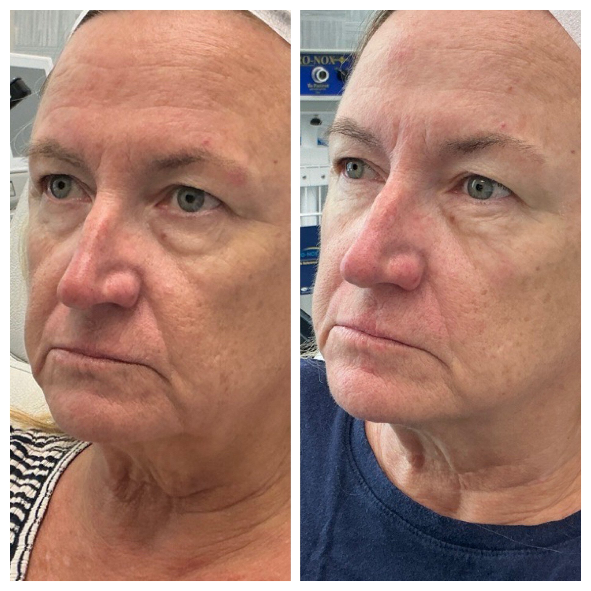 Attiva-tighening-2wks-post-1