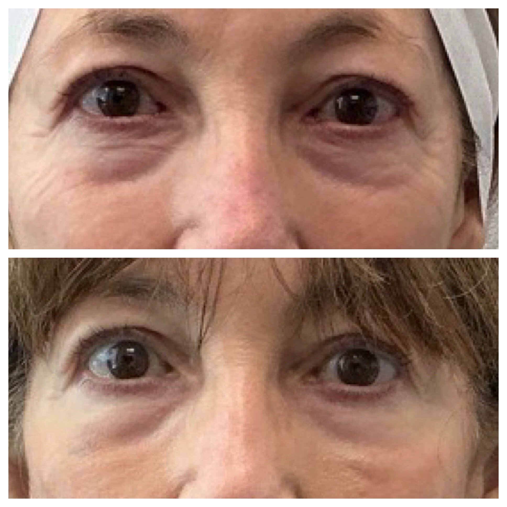 Attiva-eye-wrinkles-2wks-post-1