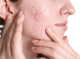 Acne Scars