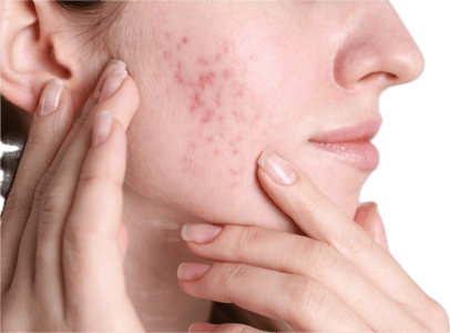 Acne Scar Treatments