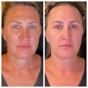 Laser Resurfacing Redness Before and After