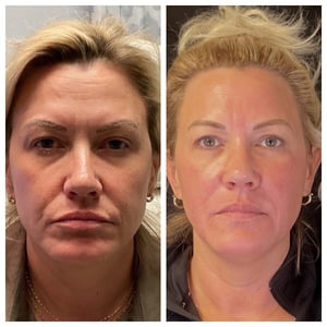 Laser Resurfacing Before and After