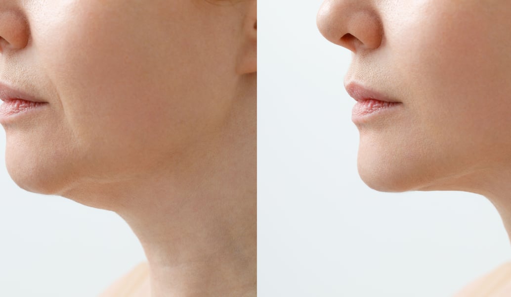 kybella-sjawc-header