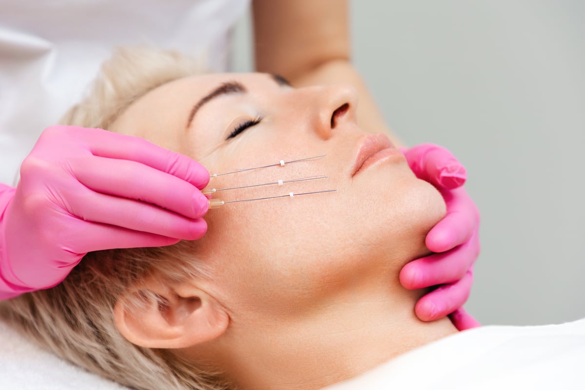 PDO Threads treatment at St. Johns Aesthetics