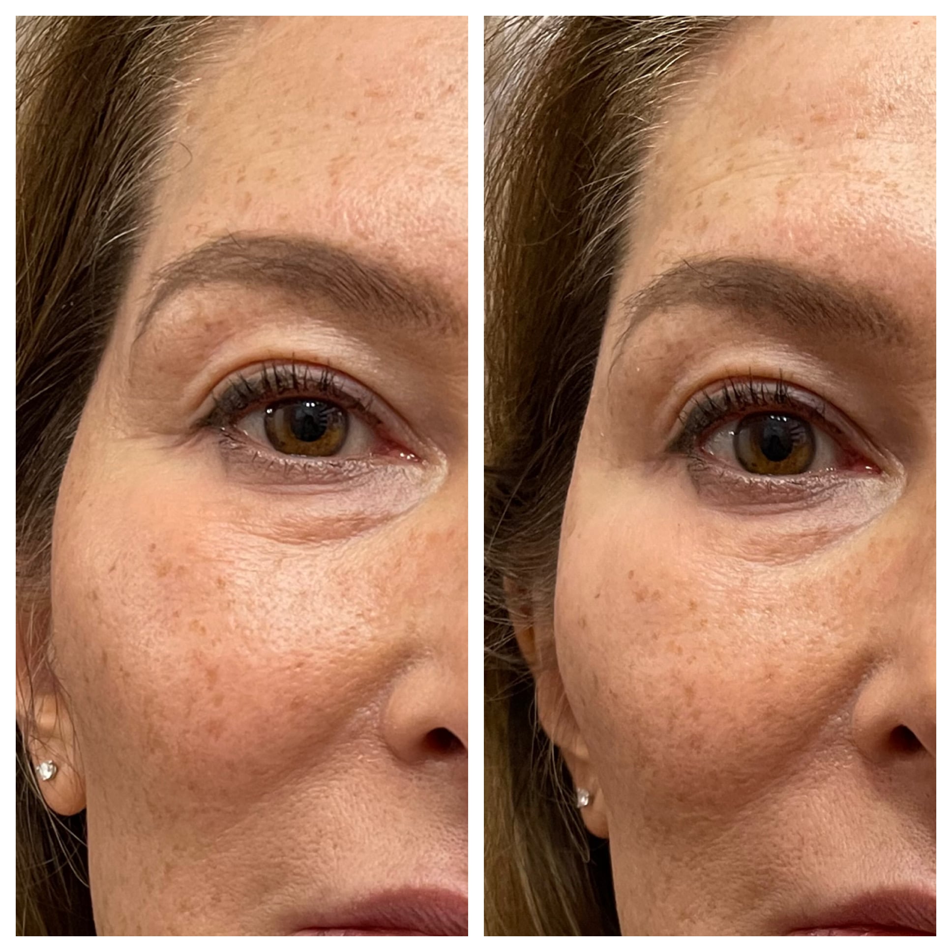 Botox crows feet before and after - St. Johns Aesthetics