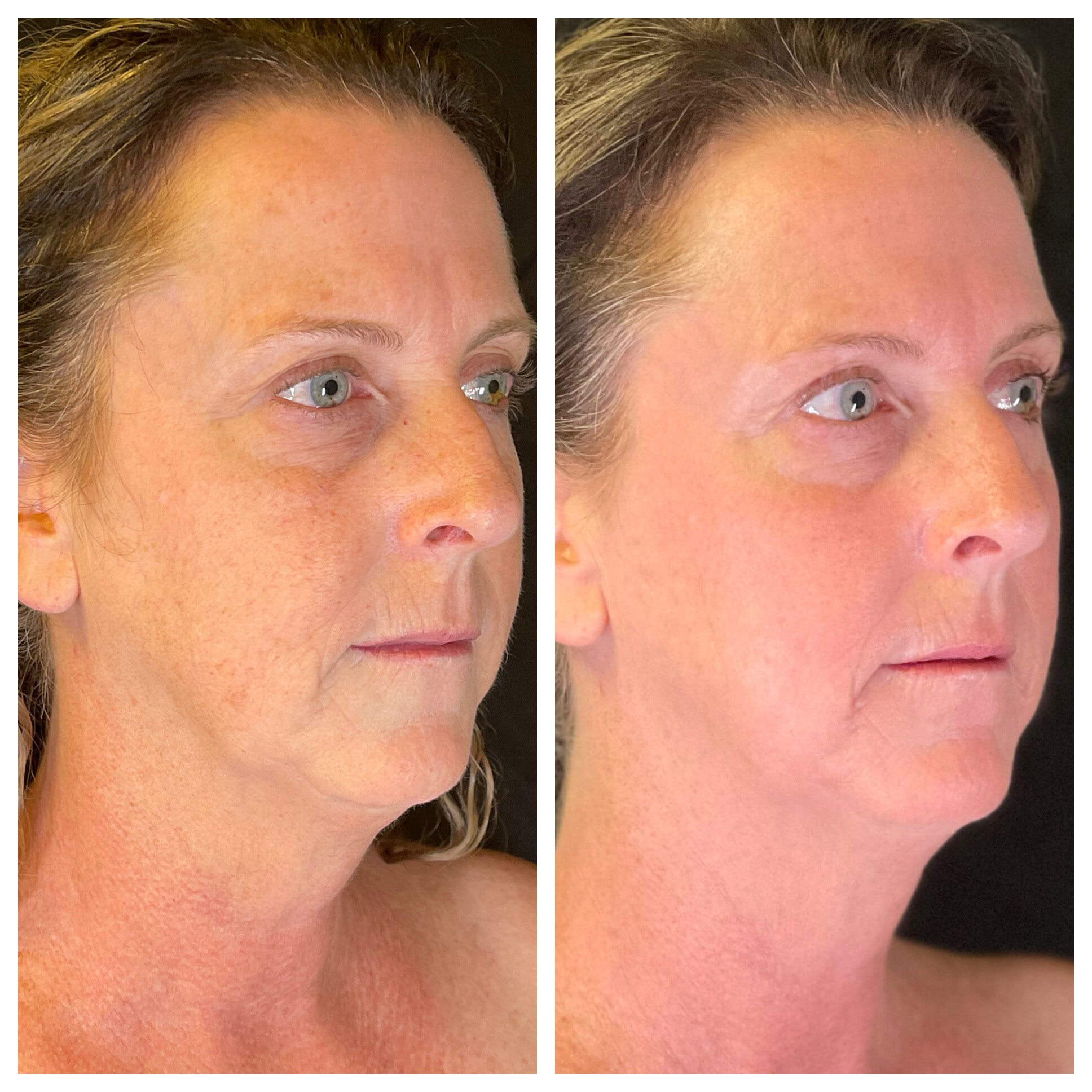 Laser resurfacing results before and after - St. Johns Aesthetics
