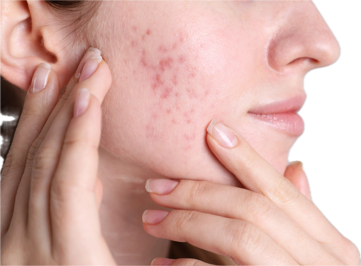 Acne Scars