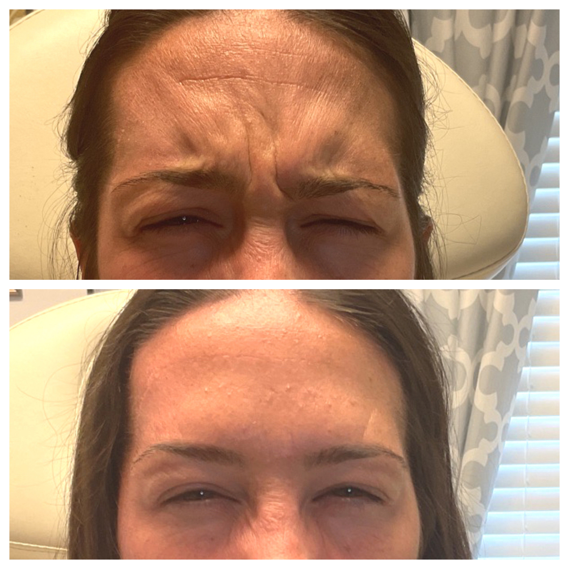 Botox elevens lines before and after - St. Johns Aesthetics