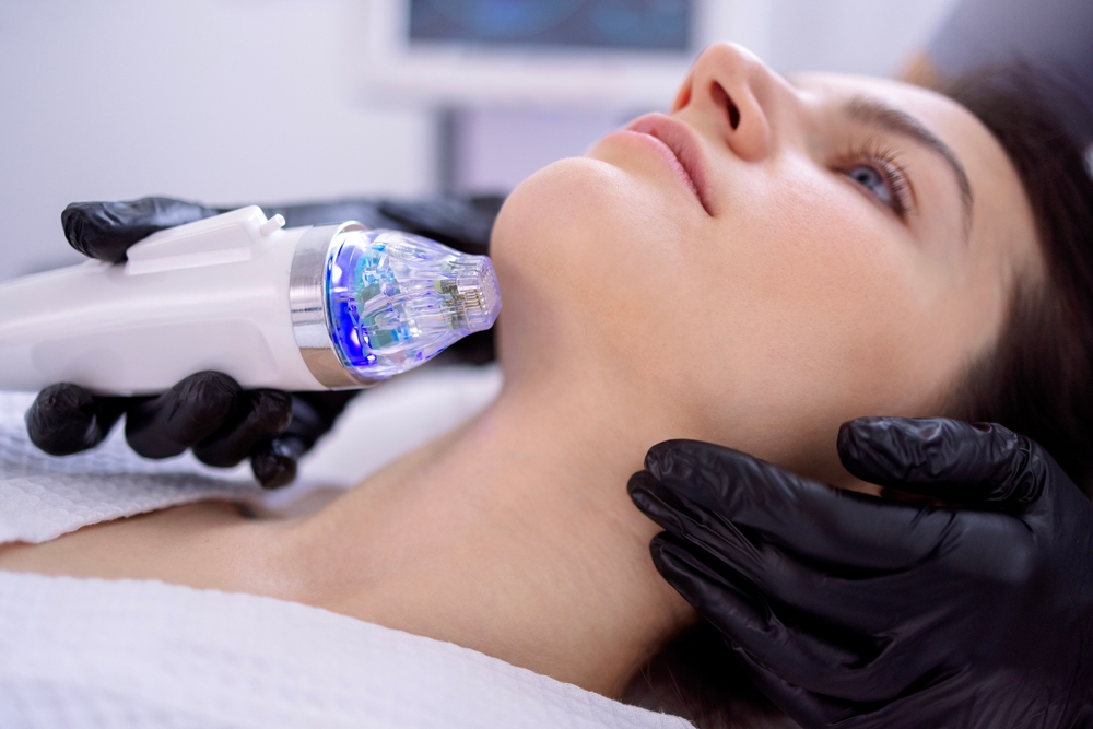 RF Microneedling ~ St Johns Aesthetics